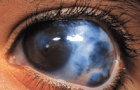 Glaucoma cases rise amid self-medication, delayed eye screening