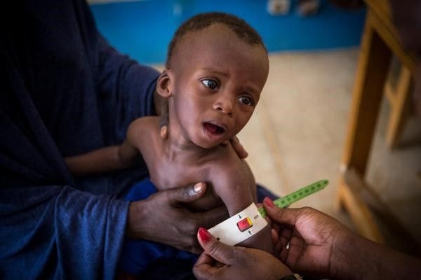 Malnutrition hindering development of countries