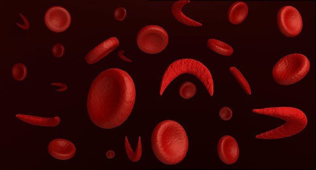 Sickle Cell Foundation of Ghana, Novartis Deploy Mobile Digital Solution to Support Newborn Screening for Sickle Cell Disease