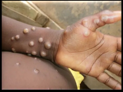 Mpox spreads across 11 districts in W/Region